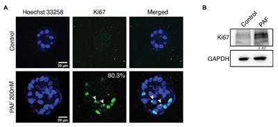 Prolonged Exposure to Platelet Activating Factor Transforms Breast Epithelial Cells